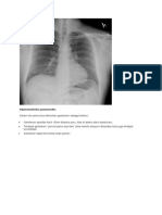 Hipersensitivitas Pneumonitis