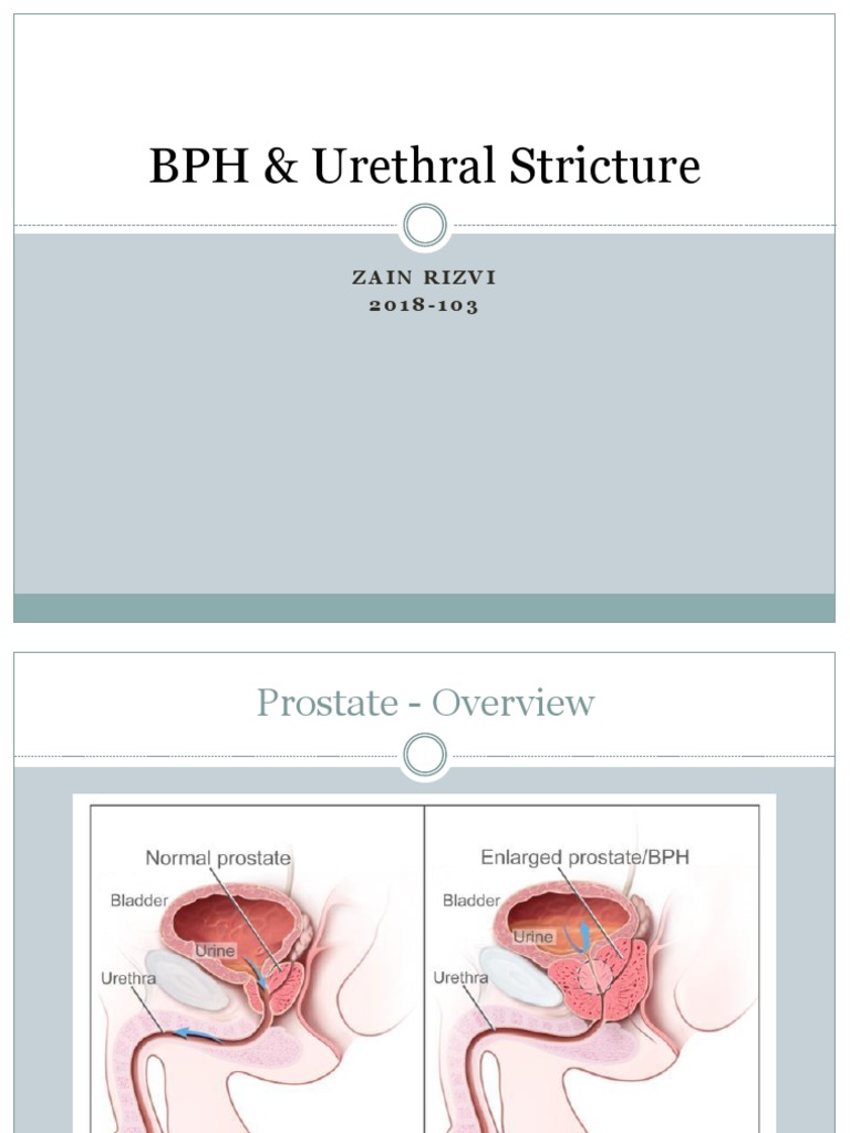 BPH and Urethral Stricture | PDF | Prostate | Genitourinary System Diseases