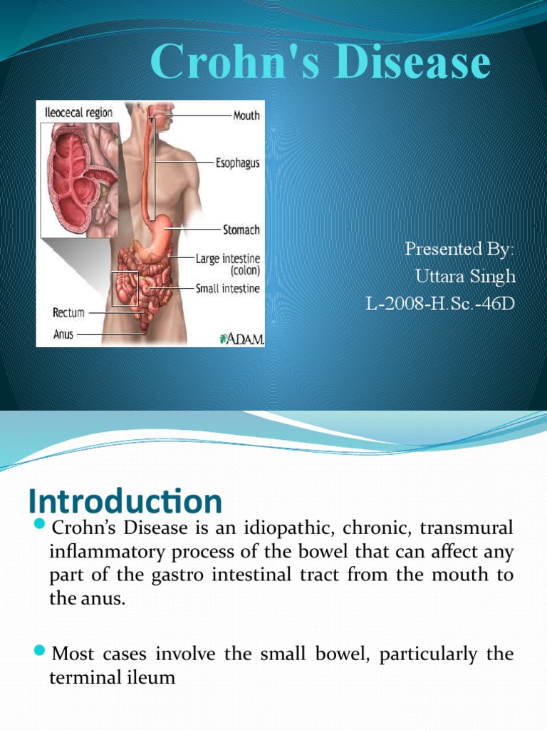 Understanding the Complexities of Crohn's Disease An InDepth Look at