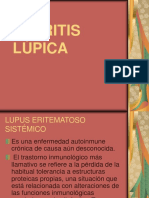 Nefritis Lupica
