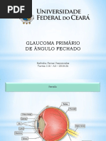 Glaucoma Primário de Ângulo Fechado