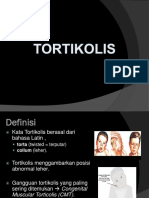 Tortikolis