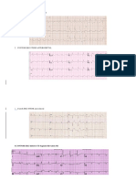 Stemi