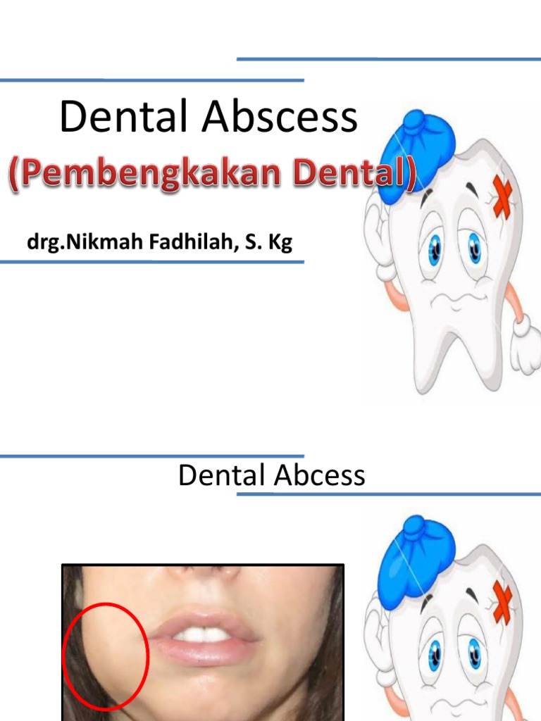 Dental Abcess PDF