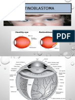 Retinoblastoma