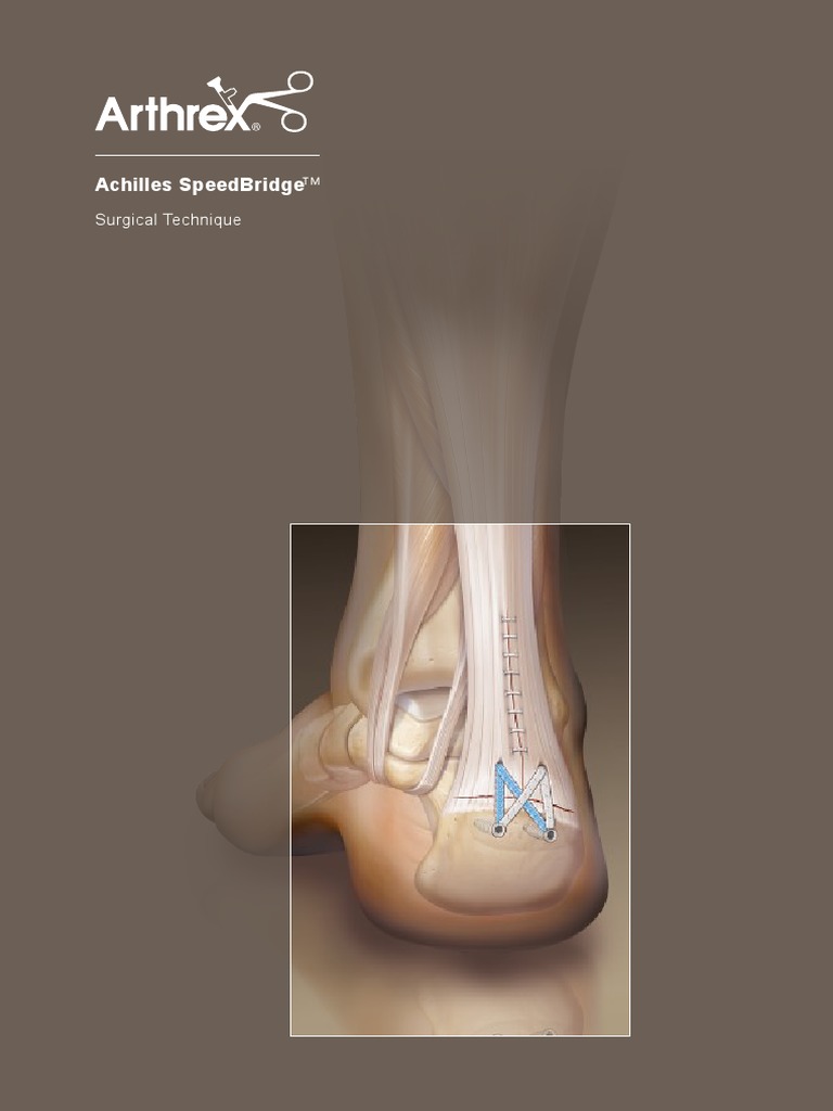 Arthrex - Achilles SpeedBridge™ Repair