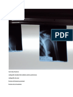 Sunt Doua Fracture: Radiografie Standard de Incidenta Antero-Posterioara Radiografie de Umar Fractura de Humerus Proximal Fractura de Col Anatomic