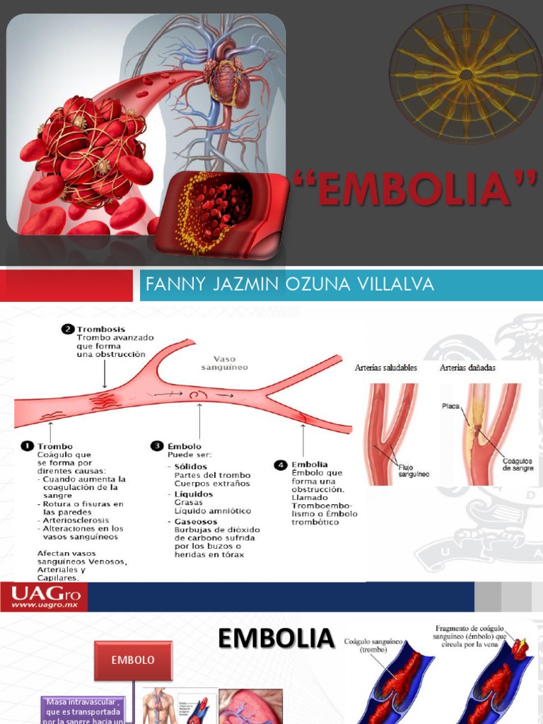 Em Bolia | PDF | Embolia | Trombo