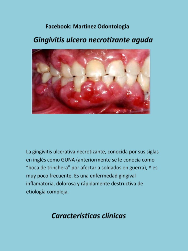 Gingivitis Ulcerativa Necrotizante Aguda PDF Especialidades Medicas
