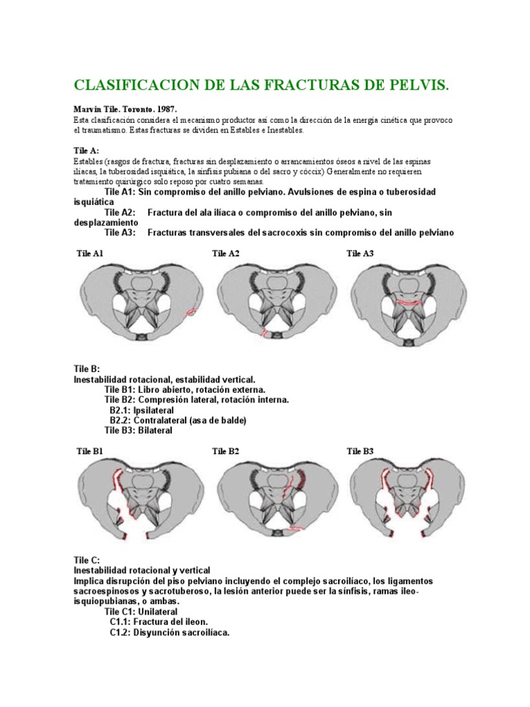 Clasificacion de Las Fracturas de Pelvis | PDF | Deportes | Pelvis