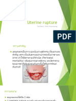 Uterine Rupture