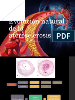 Evolución y consecuencias de la aterosclerosis