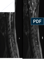 Cervical Spinal Stenosis MRI