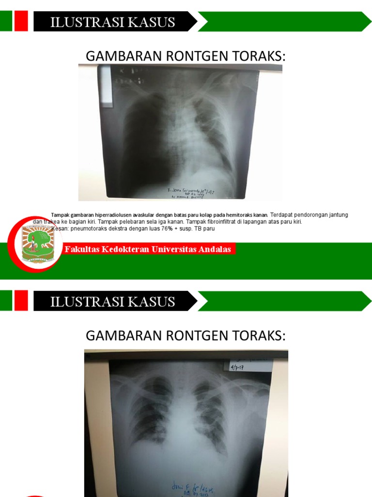 PPT CRS Pneumotoraks