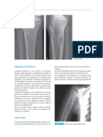 Fibroma