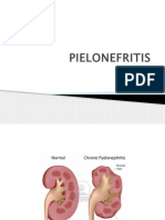 PIELONEFRITIS