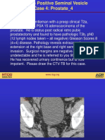 Post-Op Positive Seminal Vesicle.ppt