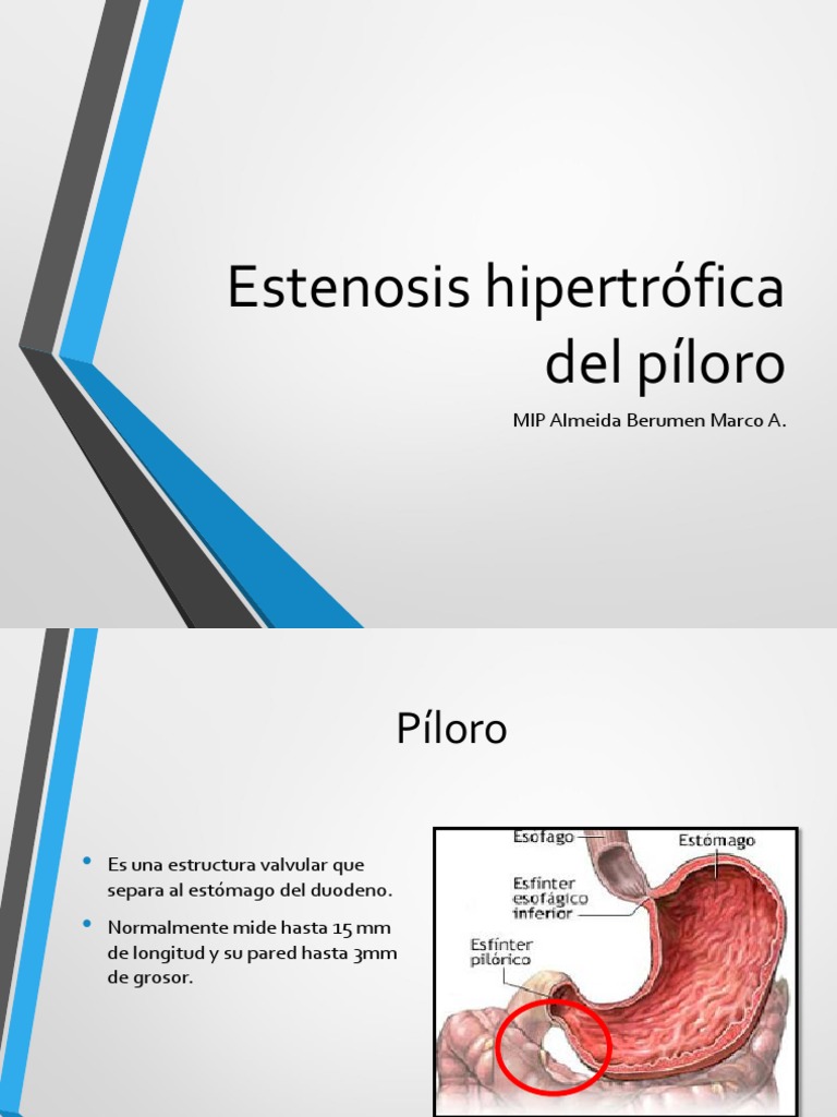Estenosis Hipertrofica Del Piloro | PDF | Deshidración | Vómitos