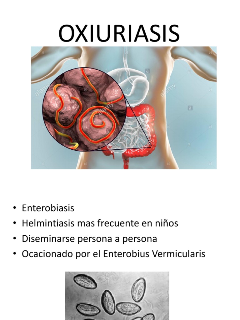 oxiuriasis of enterobiasis