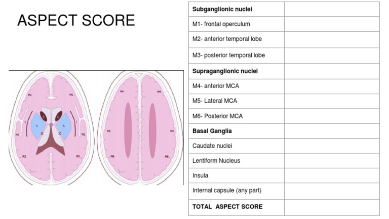 ASPECT Score Breakdown for Brain Regions | PDF