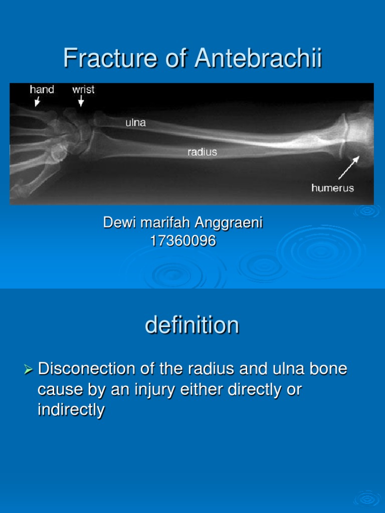 Fracture of Radius, Ulna, and Humerus | PDF | Musculoskeletal Disorders ...
