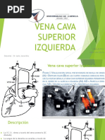 Vena Cava Superior Izquierda