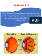 pengertian glaukoma.docx