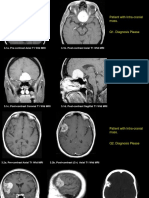 Patient With Intra-Cranial Mass.: 3.1a. Pre-Contrast Axial T1 WTD MRI 3.1b. Post-Contrast Axial T1 WTD MRI