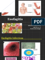 ESOFAGITIS