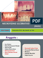NUG: Necrotizing Ulcerative Gingivitis