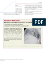 Migration of An Injectable' Loop Recorder in The Dorsal Pleural Cavity