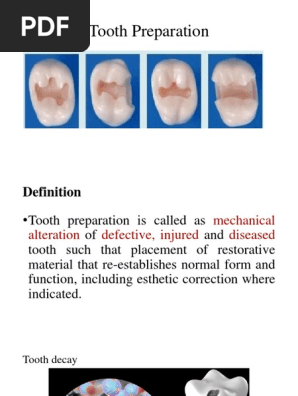 Tooth Preparation