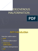 Arteriovenous Malformation