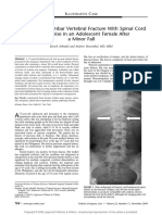 Comminuted Lumbar Vertebral Fracture With Spinal Cord Compromise in An Adolescent Female After A Minor Fall