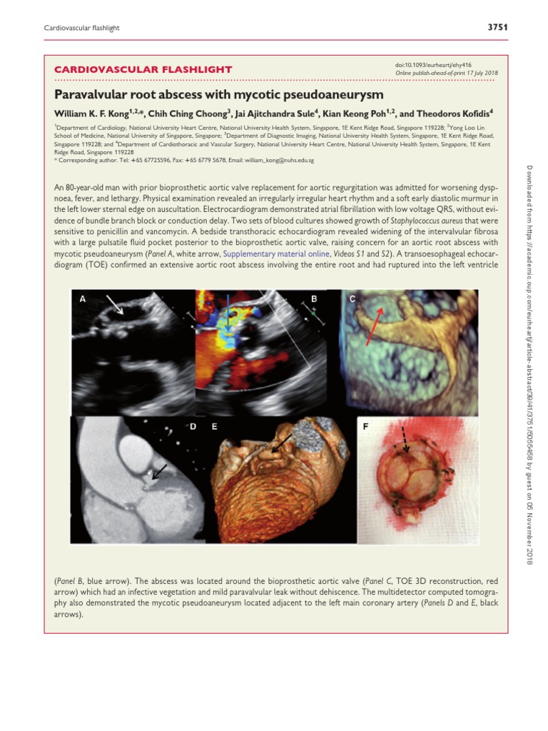 Paravalvular Abscess with Pseudoaneurysm | PDF | Heart Valve | Heart