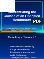 Opacified Thorax