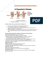 Duputren contracture