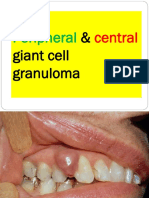 Peripheral Central Giant Cell Granuloma NXPowerLite