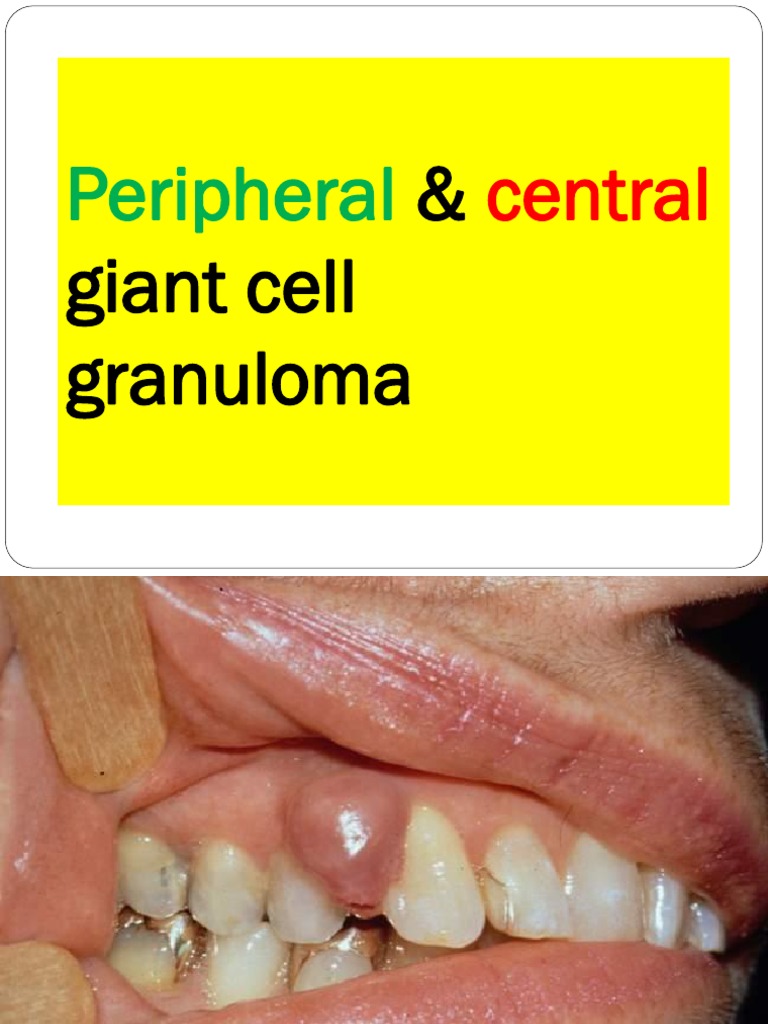 Peripheral Central Giant Cell Granuloma NXPowerLite Bone Neoplasms