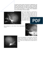 Linear Skull Fractures 