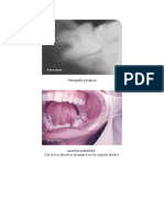 Imagenes de Cirugia de Terceros Molares