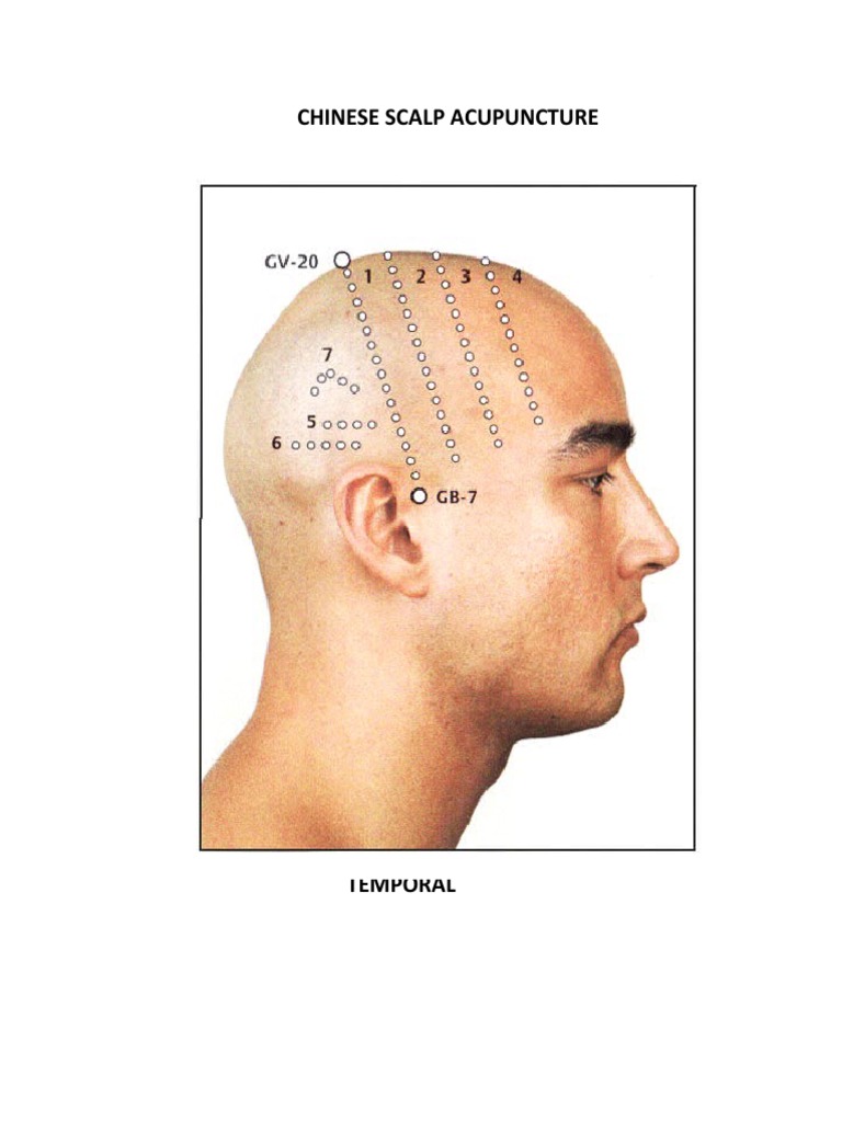 Chinese Scalp Acupuncture PDF