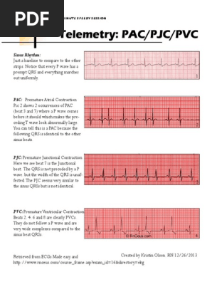 Pac Pjc Pvc Cardiac Electrophysiology Cardiac Arrhythmia