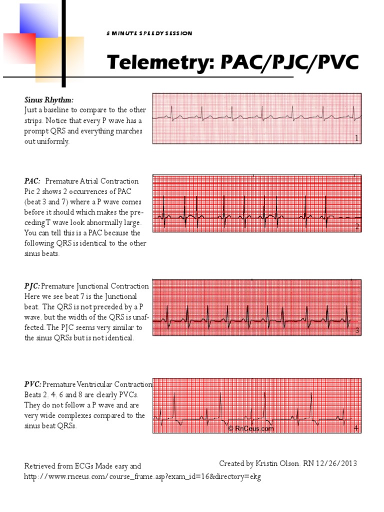 Pac PJC PVC PDF Cardiac Electrophysiology Cardiac Arrhythmia