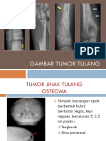 TumorTulangSEO