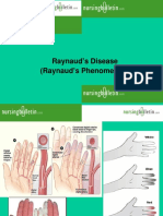Raynaud 'S Disease (Raynaud 'S Phenomenon)