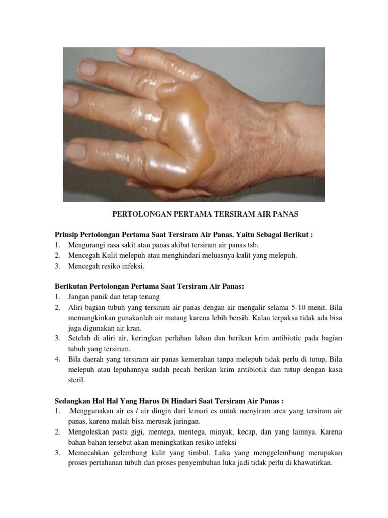 Pertolongan Pertama Tersiram Air Panas Pdf