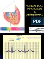 Normal Ecg, Infarction & Arrhythmias: Iqbal Lahmadi Departement of Internal Medicine Sintang - 2013