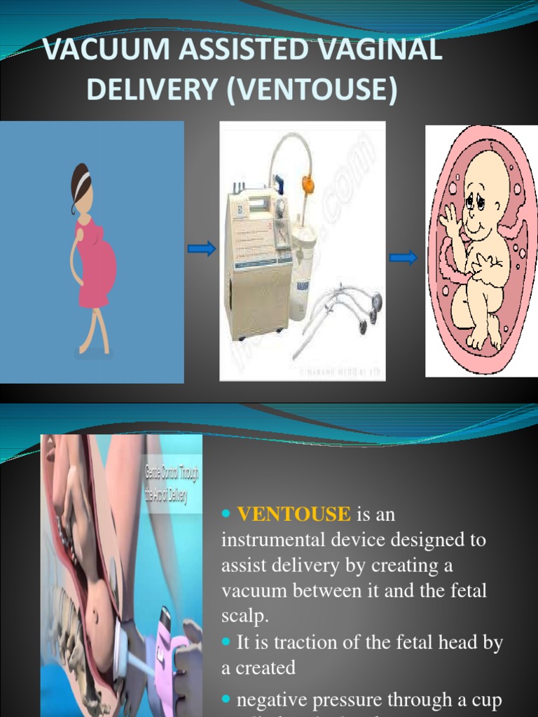 Vacuum-Assisted Vaginal Delivery Guide | PDF | Childbirth | Surgery