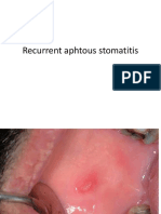 Recurrent Aphtous Stomatitis